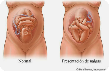 Resultado de imagen de embarazadas con bebes de nalgas